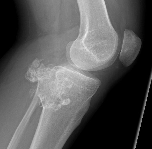 Chondrosarcoma